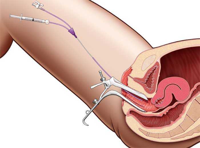 Color photo of the uterus/عکس رنگی رحم C/عکس رنگی رحم