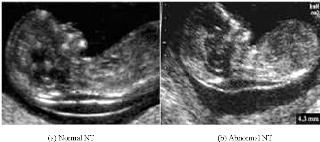 Ultrasound screening first سونوگرافی غربالگری اول| Ultrasound screening first