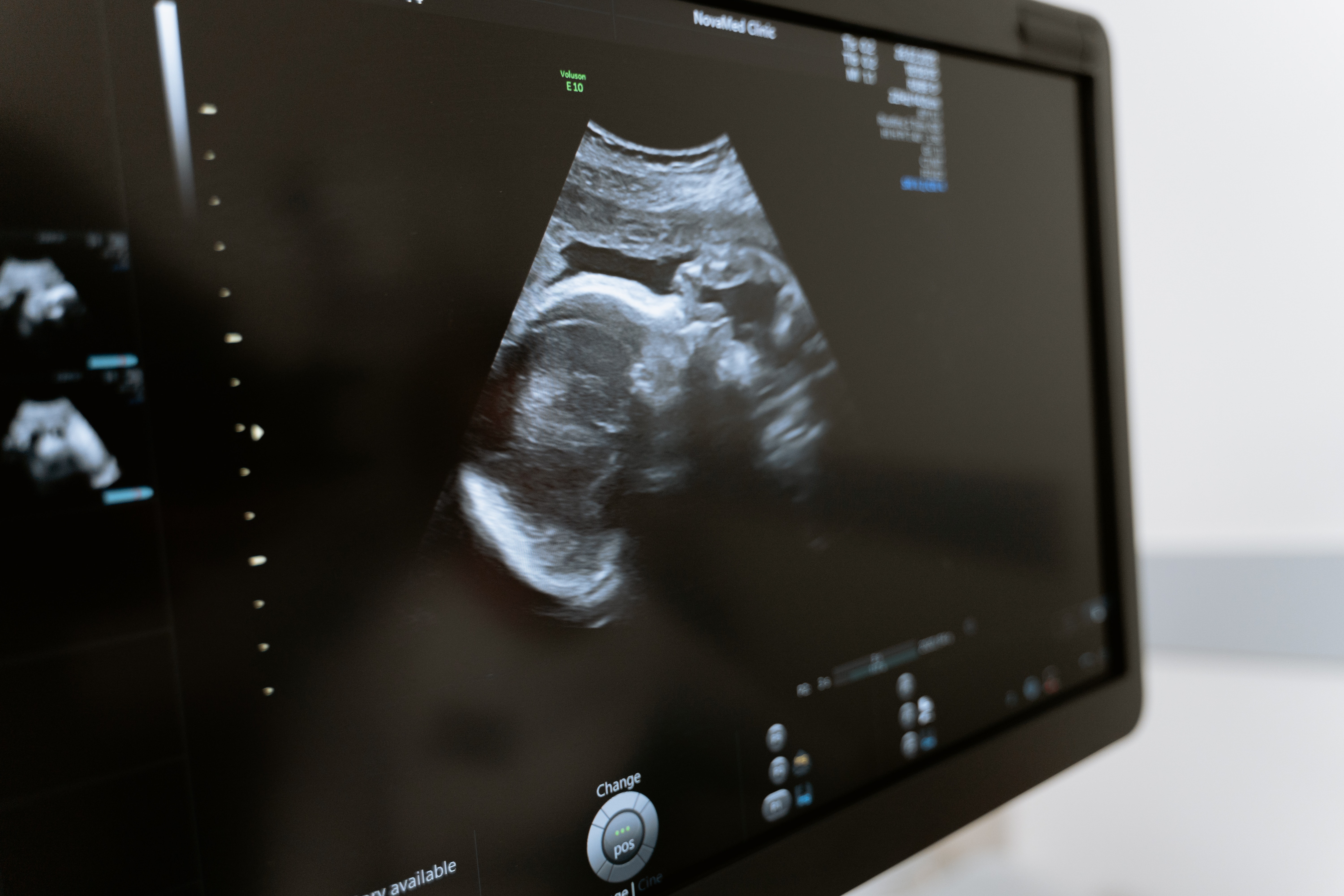 سونوگرافی حاملگی Pregnancy ultrasound/سونوگرافی حاملگی