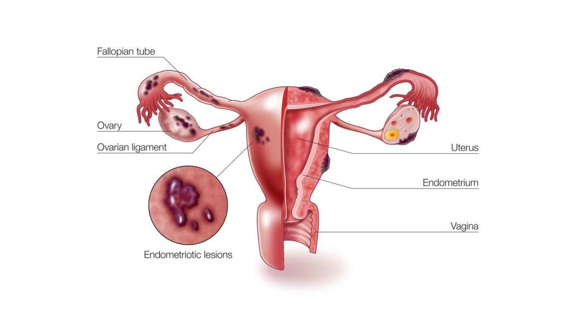 اندومتریوز endometriosis/اندومتریوز