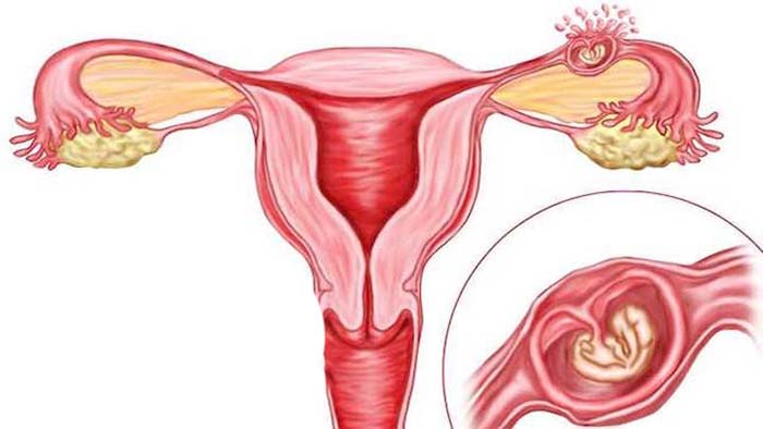 اندومتریوز endometriosis/اندومتریوز