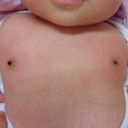 ترشح پستان chest/ترشح پستان