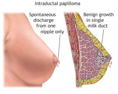 ترشح پستان chest/ترشح پستان