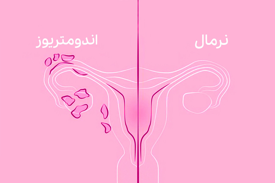 تشخیص اندومتریوز با آزمایش خون g/تشخیص اندومتریوز با آزمایش خون