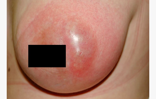 زخم ماستیت f/زخم ماستیت