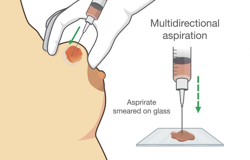 بیوپسی از پستان m/بیوپسی از پستان