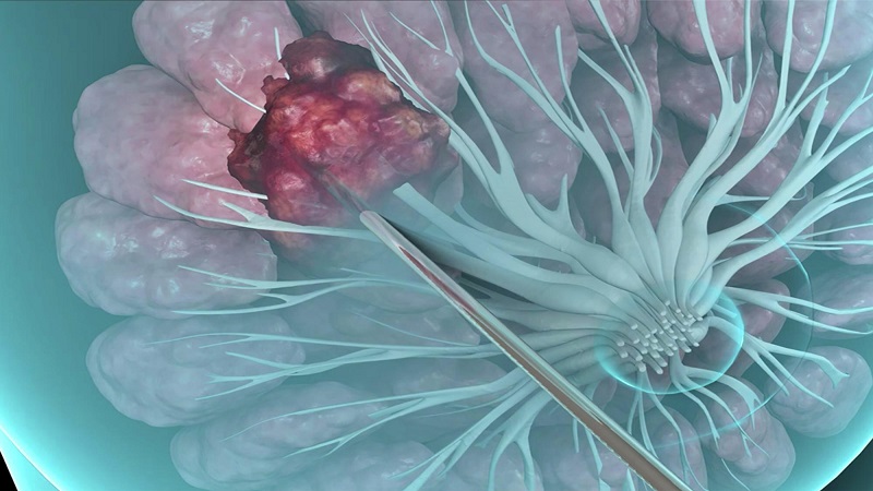 r/بیوپسی پستان