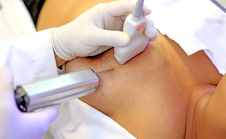 بیوپسی w/بیوپسی