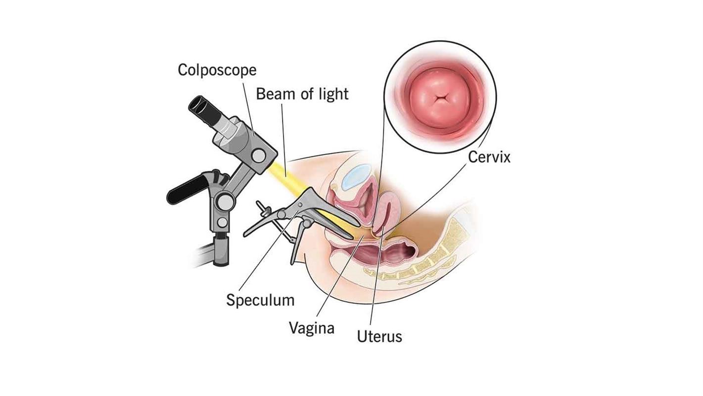 هیسترو سالپنگوگرافی d/هیسترو سالپنگوگرافی
