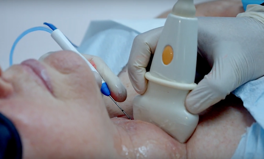 آمادگی سونو گرافی FNA تیروئید s/آمادگی سونو گرافی FNA تیروئید