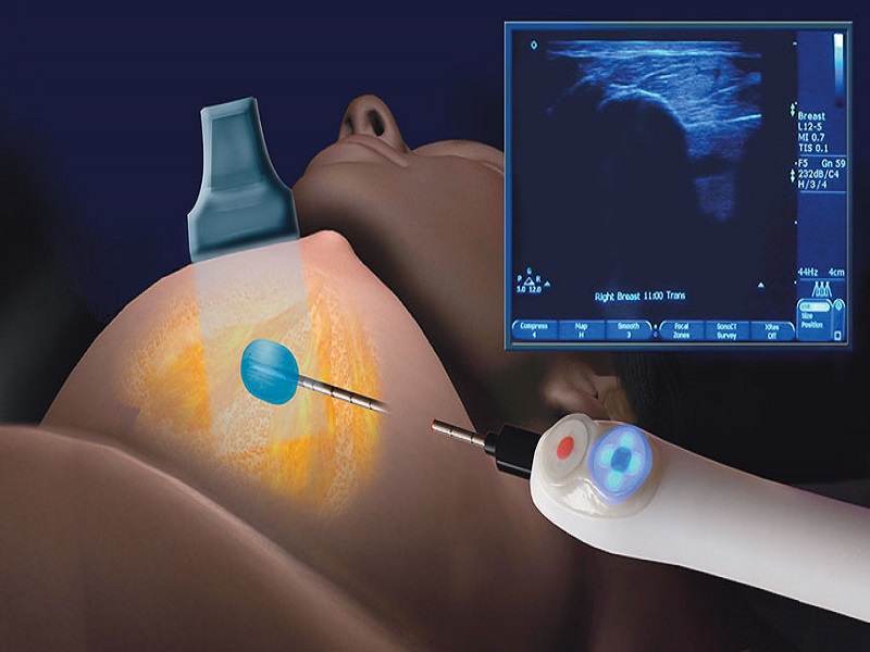 آمادگی سونو گرافی بیوپسی برست s/آمادگی سونو گرافی بیوپسی برست