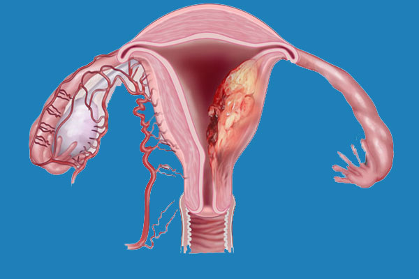 اندومتریوز D/اندومتریوز