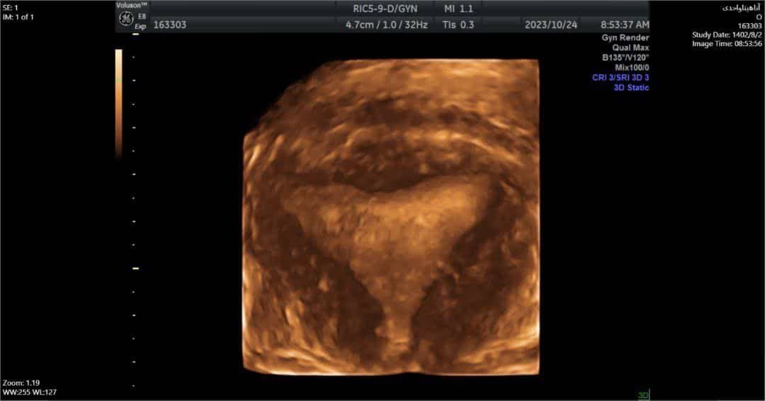 هزینه سونوگرافی سه بعدی رحم F/هزینه سونوگرافی سه بعدی رحم