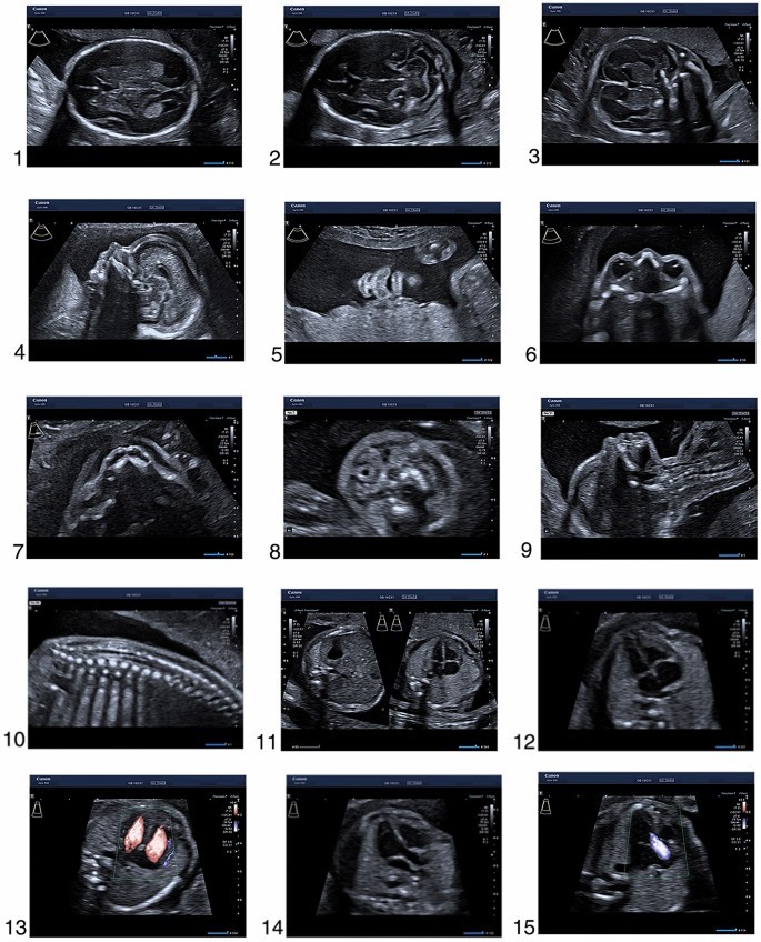 سونوگرافی غربالگری جنین سه ماهه دوم m/سونوگرافی غربالگری جنین سه ماهه دوم