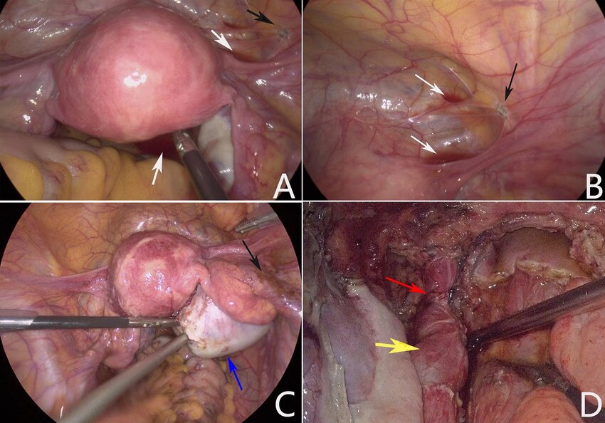 اندومتریوز K/اندومتریوز