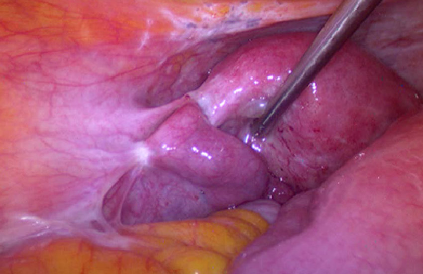 اندومتریوز T/اندومتریوز