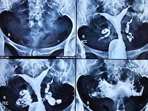 هیستروسالپنگوگرافی e/هیستروسالپنگوگرافی