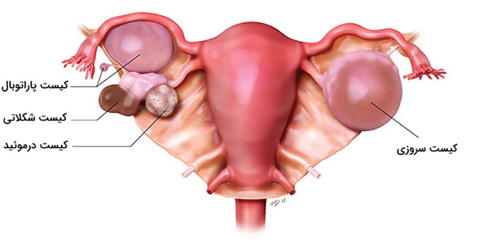 اندومتریوز s/اندومتریوز