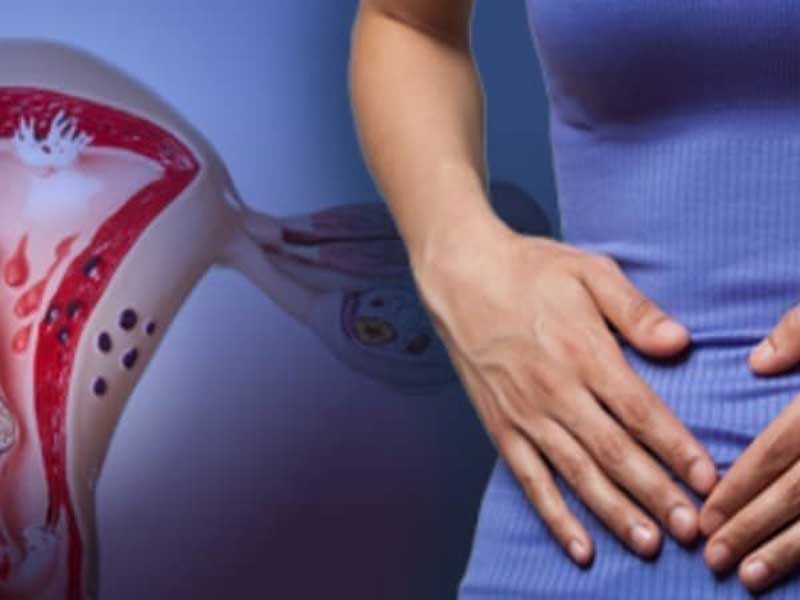 علائم اندومتریوز r/علائم اندومتریوز