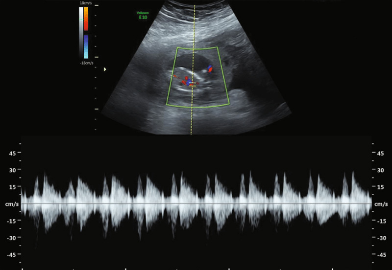 اکوکاردیوگرافی جنین a/اکوکاردیوگرافی جنین