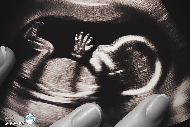 سونوگرافی انومالی اسکن s/سونوگرافی انومالی اسکن