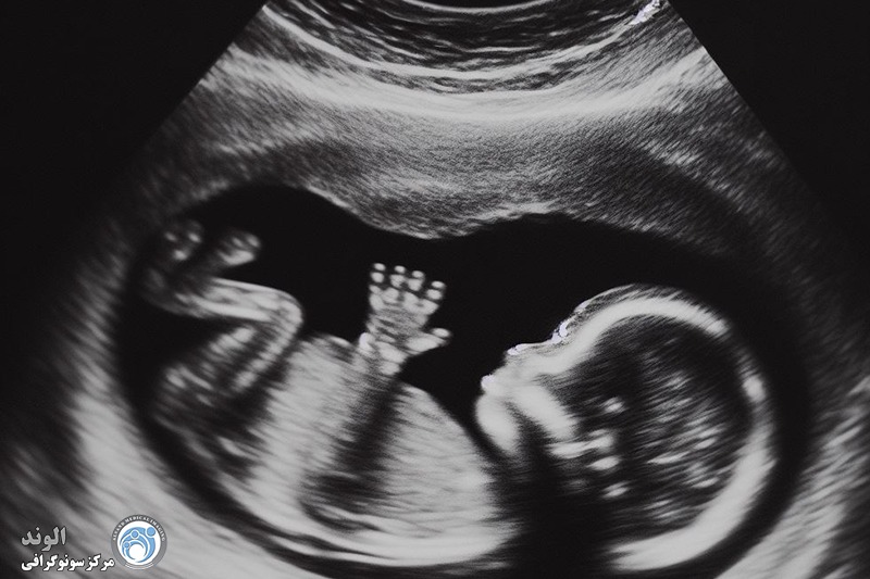 سونوگرافی انومالی اسکن f/سونوگرافی انومالی اسکن