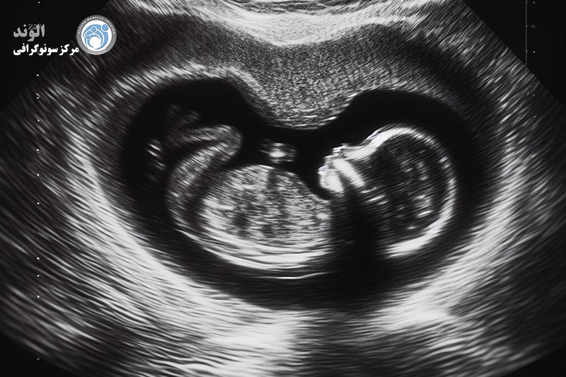 اکوکاردیوگرافی جنین d/اکوکاردیوگرافی جنین