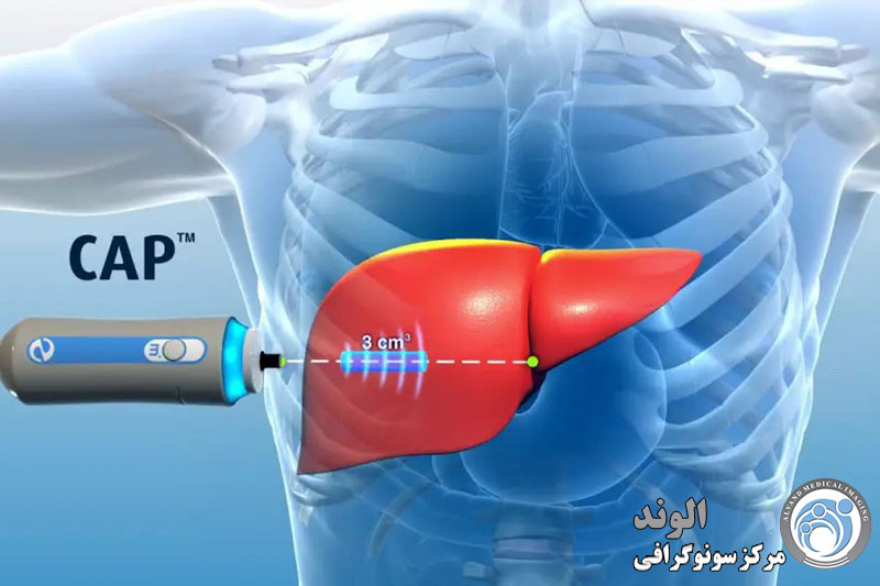 f/فیبرواسکن کبد در تهران فیبرواسکن کبد در تهران