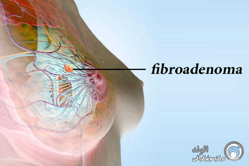 d/فیبروآدنوم