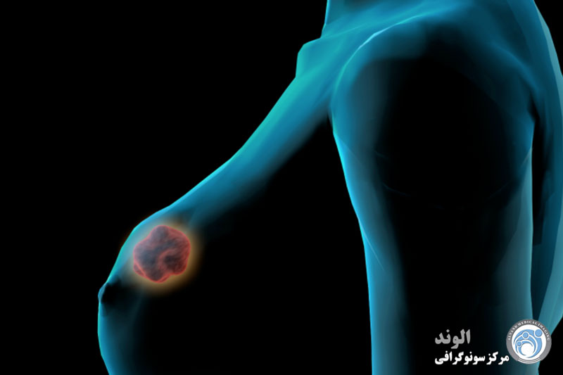 فیبروآدنوم