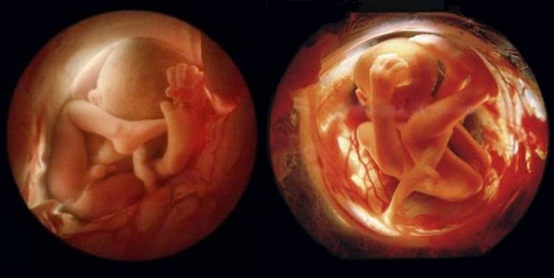 اکوکاردیوگرافی جنین y/اکوکاردیوگرافی جنین