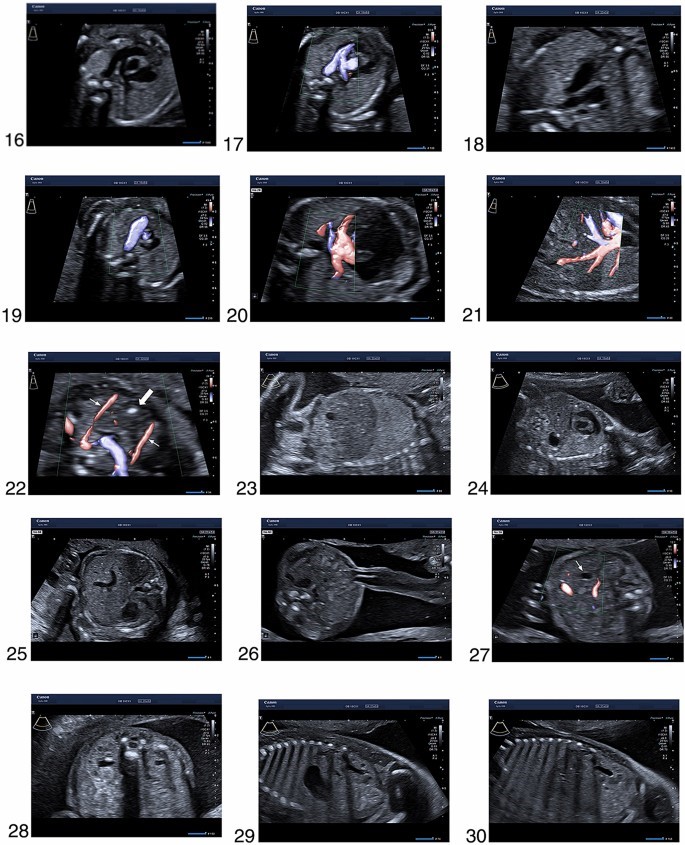 سونوگرافی غربالگری جنین سه ماهه دوم m/سونوگرافی غربالگری جنین سه ماهه دوم