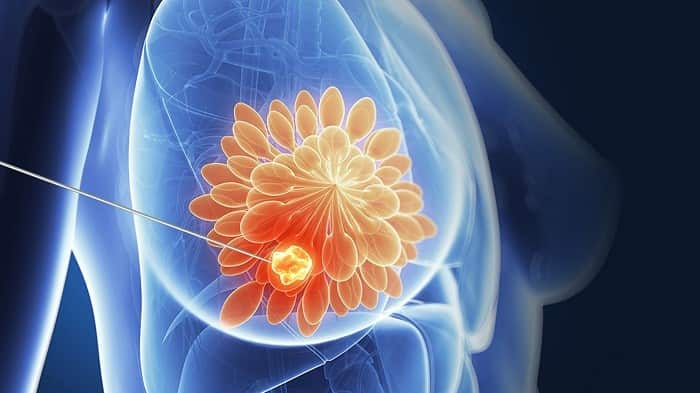 بیوپسی سینه d/بیوپسی سینه