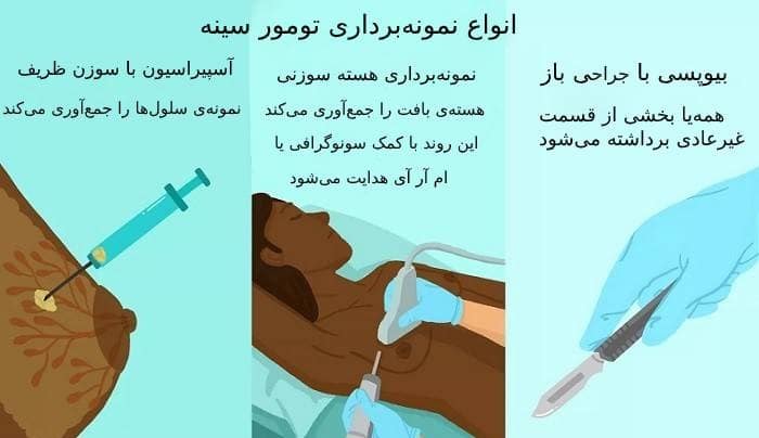 بیوپسی سینه i/بیوپسی سینه