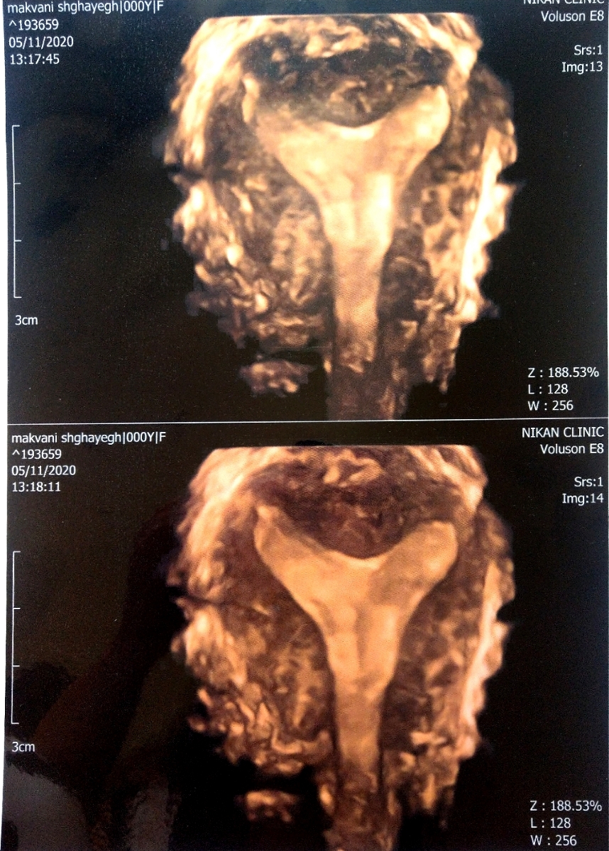 سونوگرافی سه بعدی رحم d/سونوگرافی سه بعدی رحم