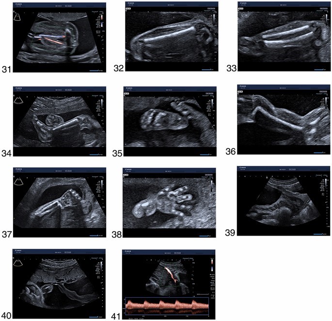 سونوگرافی غربالگری جنین سه ماهه دوم m/سونوگرافی غربالگری جنین سه ماهه دوم