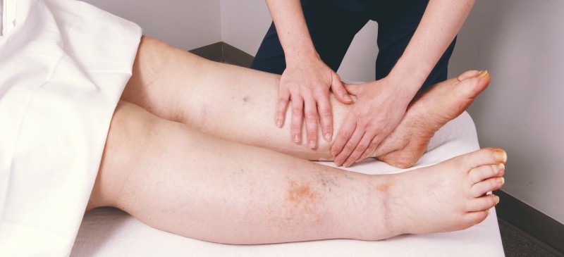 درمان لنف ادم چیست؟ E/درمان لنف ادم چیست؟