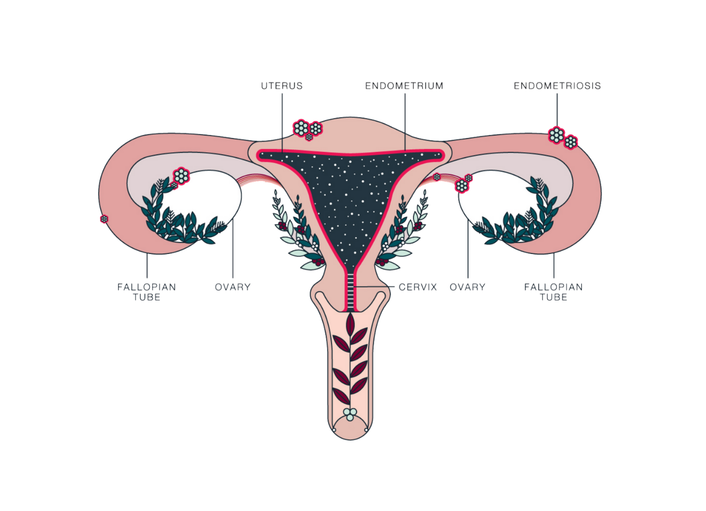 اندومتریوز S/اندومتریوز