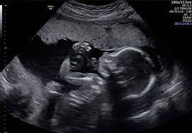 سونوگرافی انومالی اسکن D/سونوگرافی انومالی اسکن