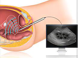 سونوگرافی سه بعدی واژینال j/سونوگرافی سه بعدی واژینال