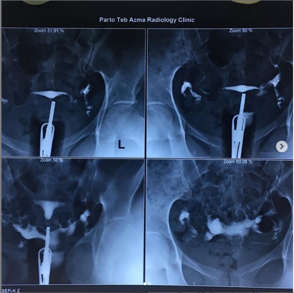 هیستروسالپنگوگرافی g/هیستروسالپنگوگرافی