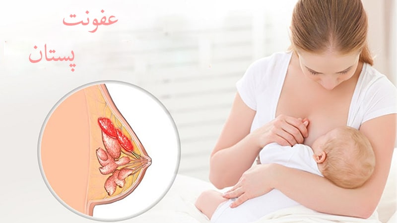 عفونت پستان h/عفونت پستان