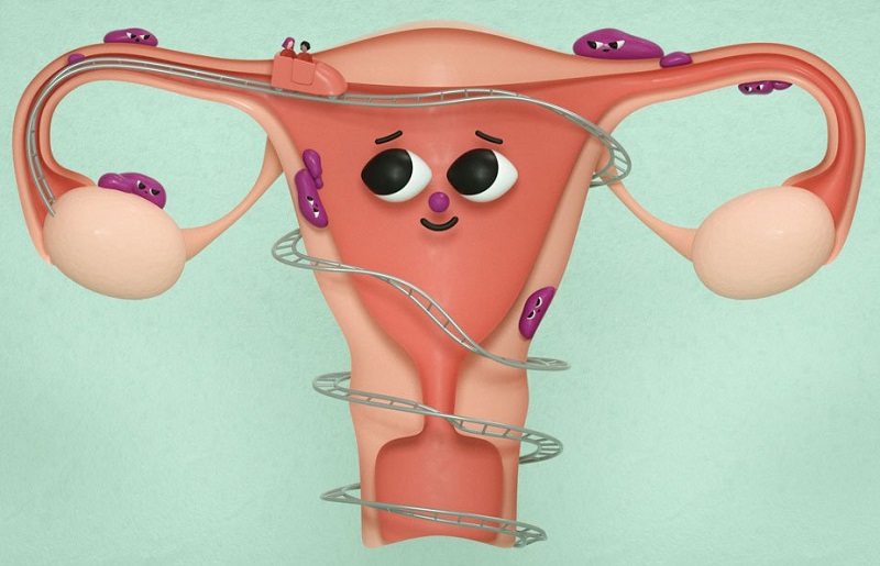 علائم اندومتریوز g/علائم اندومتریوز