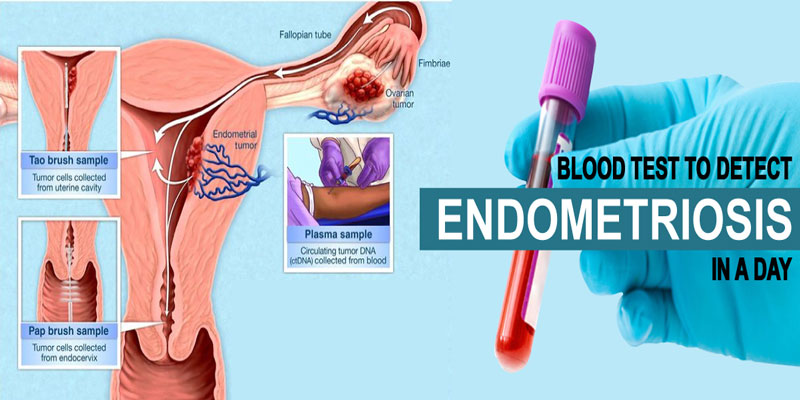 تشخیص اندومتریوز باآزمایش خون g/تشخیص اندومتریوز باآزمایش خون