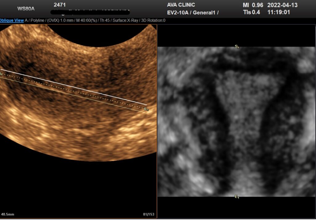 سونوگرافی سه بعدی رحم j/سونوگرافی سه بعدی رحم
