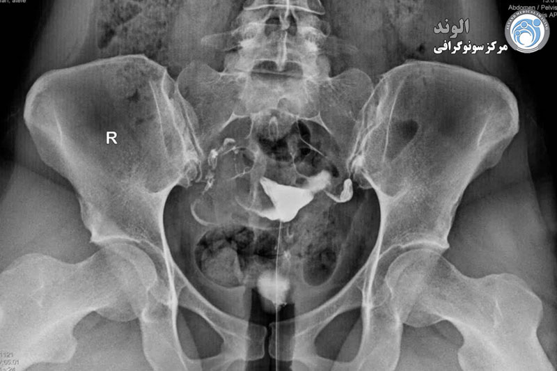 s/هیستروسالپنگوگرافی هیستروسالپنگوگرافی