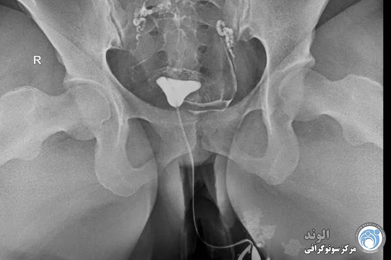 d/هیستروسالپنگوگرافی هیستروسالپنگوگرافی
