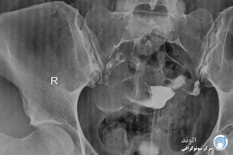 k/هیستروسالپنگوگرافی هیستروسالپنگوگرافی