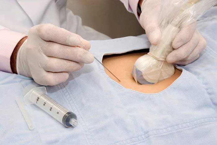 بیوپسی سینه در تهران D/بیوپسی سینه در تهران