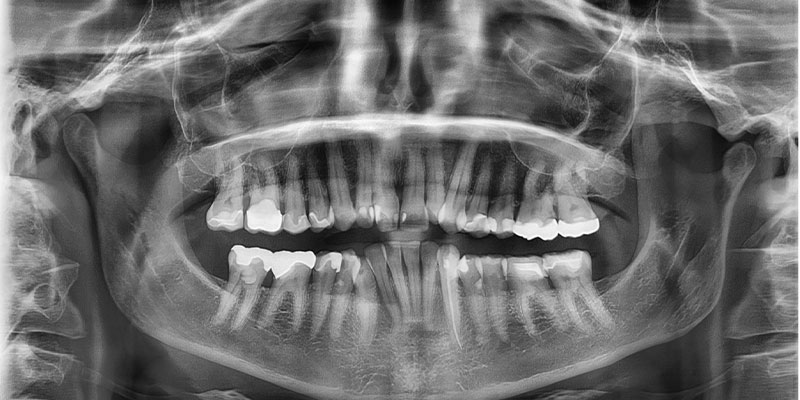 عکس opg A/عکس opg